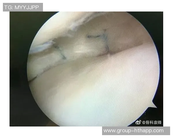 主刀医生透露迪巴拉外侧半月板完全撕裂术后恢复需45天时间